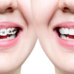 From Metal to Clear: Exploring Different Types of Dental Braces